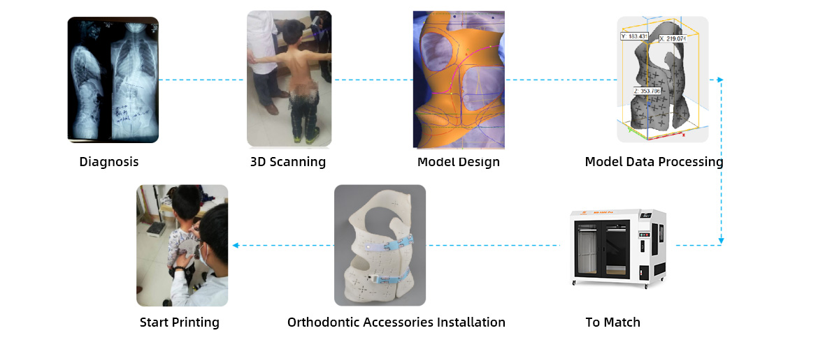 How 3D Printed Back Braces for Effective Scoliosis Treatment?(图2)