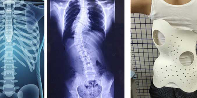 How 3D Printed Back Braces for Effective Scoliosis Treatment?(图1)